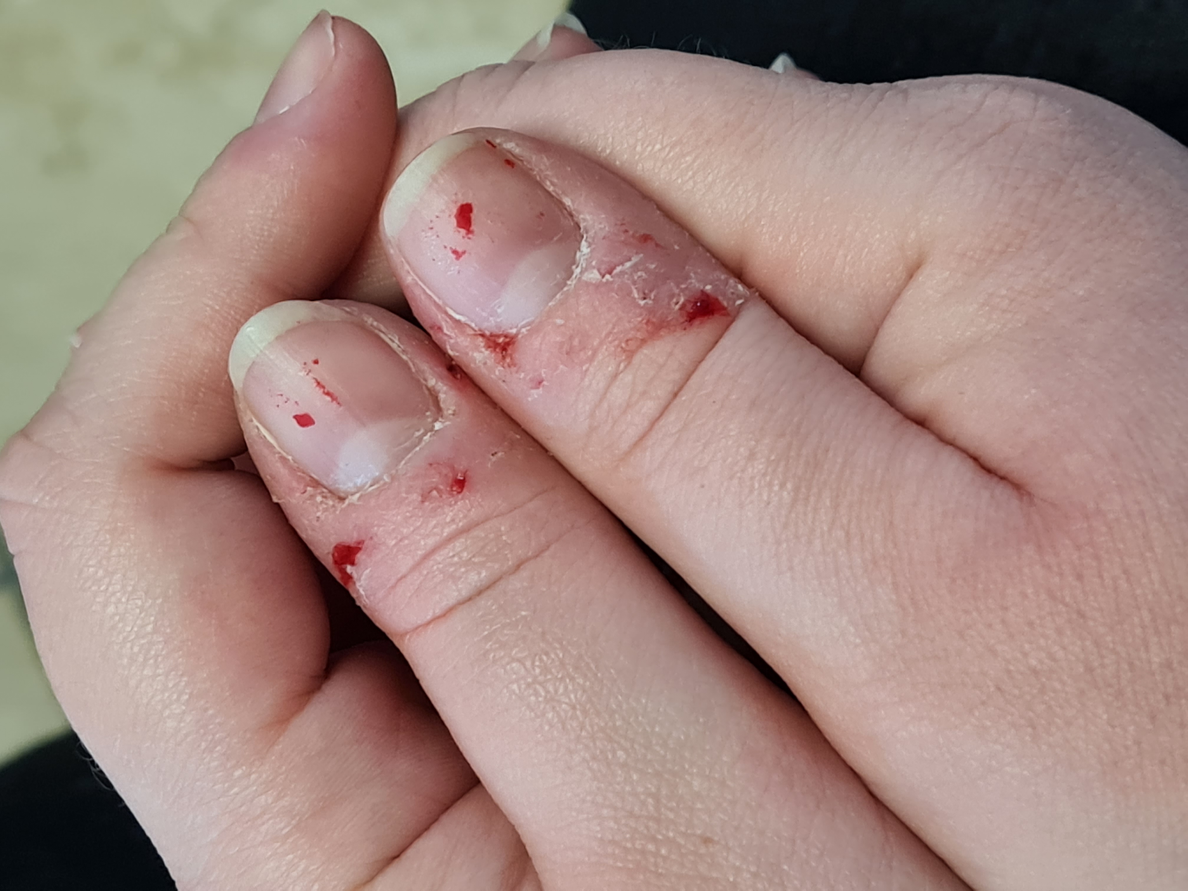 A picture of fingers with the skin picked and bloody, due to Dermatillomania - a representation of anxiety. 