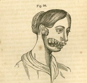 A drawing depicting a woman suffering from necrosis of the jaw (colloquially known as 'phossy jaw'.
